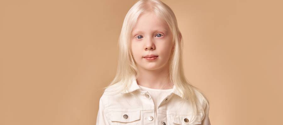 Albino bir çocuk, açık renkli saçlara, soluk ten rengine ve açık mavi gözlere sahip. Bej arka plan önünde beyaz ceket giymiş şekilde kameraya bakıyor.