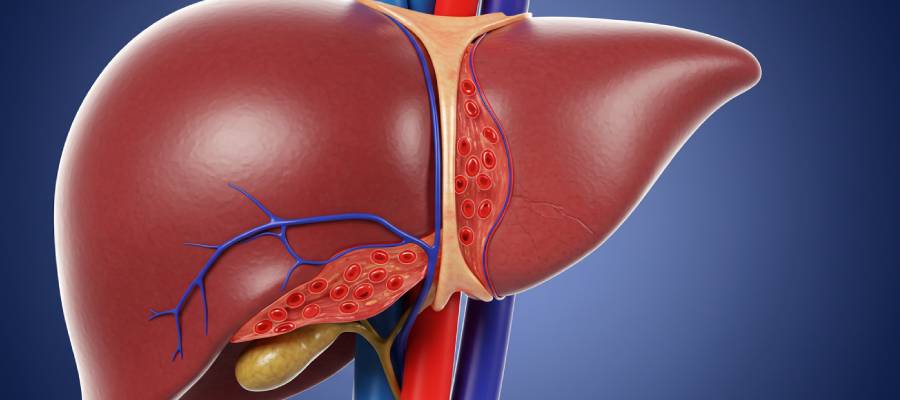 Budd-Chiari sendromunu göstermek amacıyla hazırlanmış, karaciğerin damar yapısını ve tıkanmış hepatik venleri detaylı şekilde gösteren 3D tıbbi illüstrasyon.