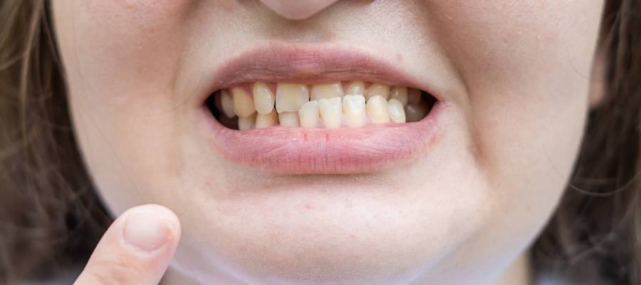 Diş tedavisi sırasında ağzın uzun süre açık kalması veya stres kaynaklı kas gerginliği de çene çıkmasına neden olabilir.