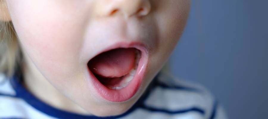 Ağzını açmış halde duran küçük bir çocuk, dil altı bağı (frenulum) net şekilde görülüyor.