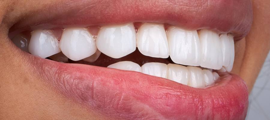 Beyaz ve düzgün hizalanmış dişlere sahip bir bireyin yakından çekilmiş gülümsemesi.