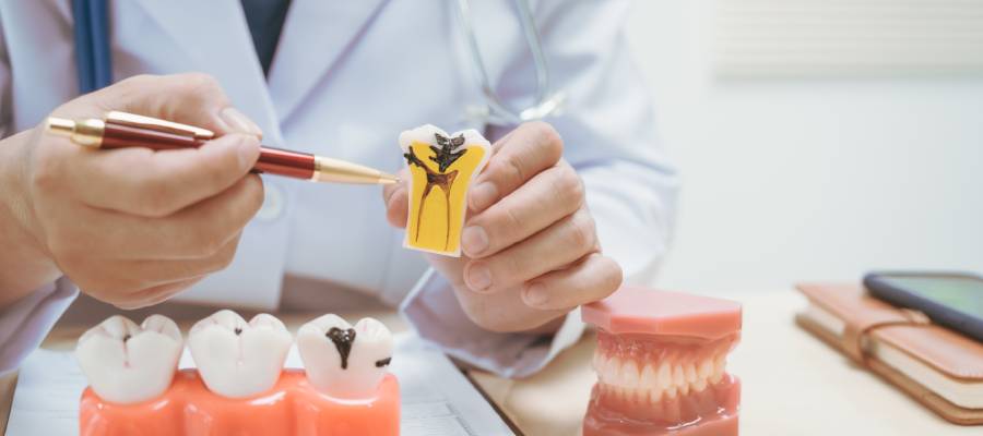 Diş çürükleri, mineyi zayıflatarak diş kırılmasının en yaygın nedenlerinden biridir.