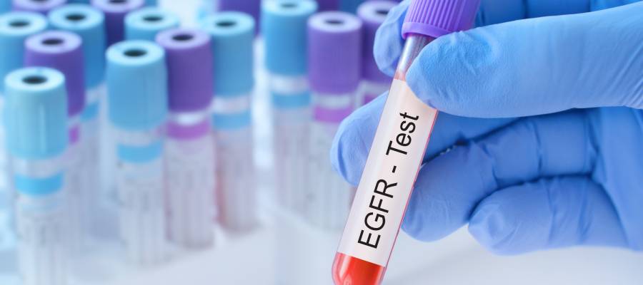 EGFR testi için kullanılan, mor kapaklı kan tüpünü eldivenli bir el tutuyor; arka planda laboratuvar ortamında diğer kan örnekleri görülüyor.