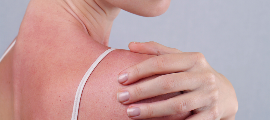 Omuz ve sırt bölgesinde ciddi şekilde kızarmış, güneş yanığına maruz kalmış bir cildi tutan kadın eli