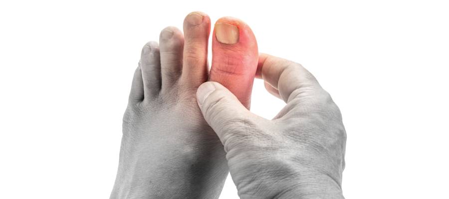 Şişmiş, kızarmış ve ağrılı olduğu anlaşılan bir ayak başparmağını tutan bir el. Gut hastalığı belirtisi.