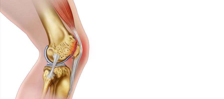 Diz kapağının arkasında yer alan kıkırdak, çeşitli nedenlere bağlı olarak aşınabilir.
