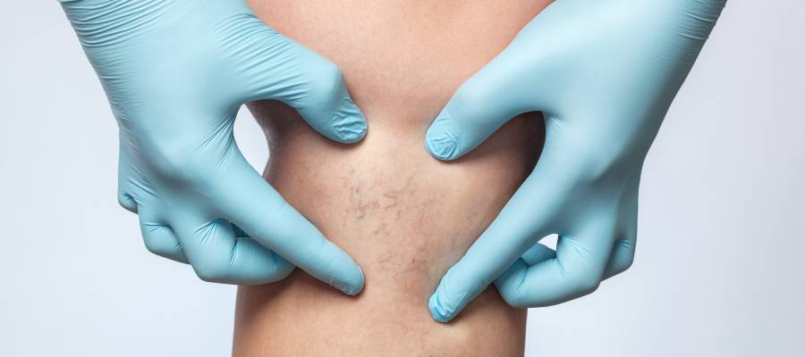 Telenjiektazi hastalığı, gösterdiği semptomlar ile farklı şekillerde görülebilir.