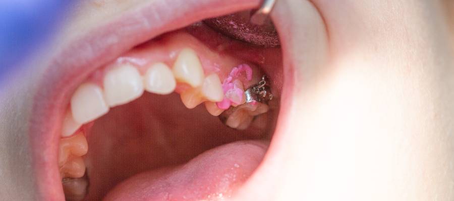 Diş tedavisi sonrası trismus meydana gelebilir. 