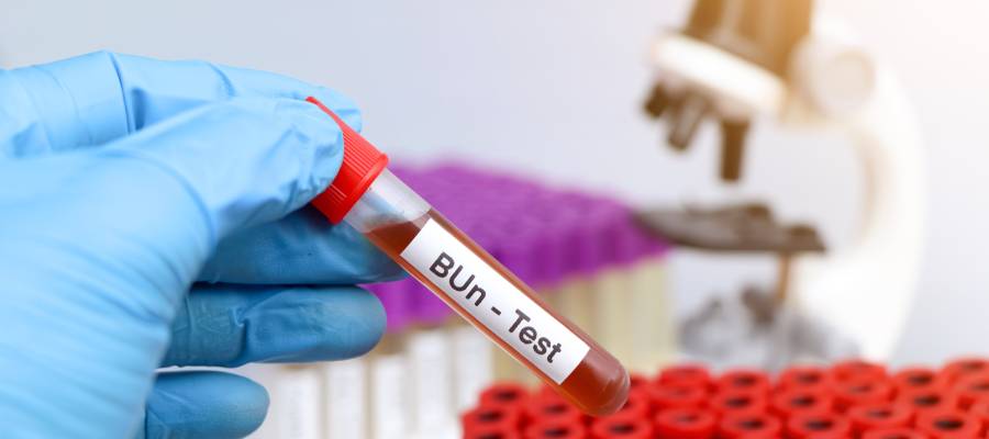 Eldiven giymiş bir kişinin elinde, üzerinde 'BUN - Test' yazan kan örneği tüpü tutulmaktadır. Arka planda laboratuvar ortamı ve mikroskop görünmektedir.