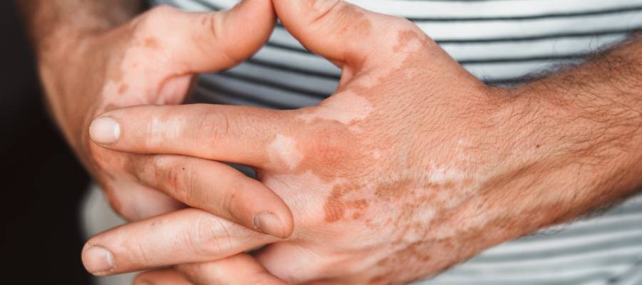 Vitiligo hastalığına bağlı olarak ellerde görülen beyaz lekeler; ciltte pigment kaybı yaşanan alanlar, parmak aralarında ve el sırtında belirgin renk değişiklikleri.