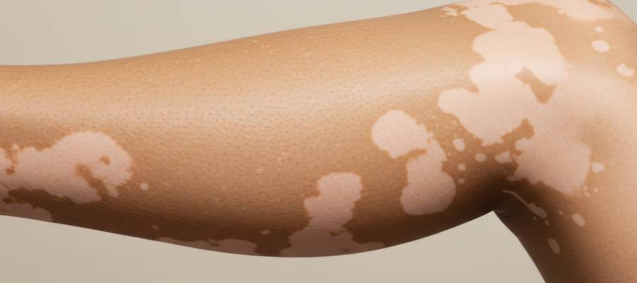 Kol üzerinde vitiligoya bağlı, sınırları belirgin, süt beyazı renk değişikliği gösteren düzensiz yamalar.