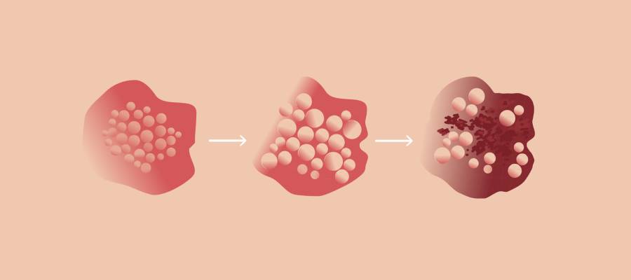 Zona hastalığında deri döküntüsünün evreleri: İlk aşamada hafif kızarıklık ve kabarcık başlangıcı, ikinci aşamada daha belirgin sıvı dolu kabarcıklar, üçüncü aşamada ise kabarcıkların patlaması ve kabuklanma görülmektedir.