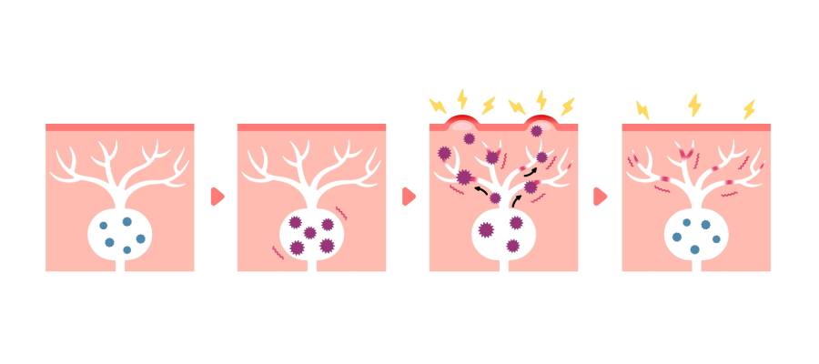 Zona hastalığının sinir hücresinde latent kalan virüsün yeniden aktifleşmesi sürecini gösteren illüstrasyon. Görselde virüsün sinir köklerinde uykuda kaldığı, bağışıklık zayıflayınca aktifleştiği, sinir yolları boyunca ilerleyerek ciltte döküntü ve ağrıya neden olduğu aşamalar gösteriliyor.