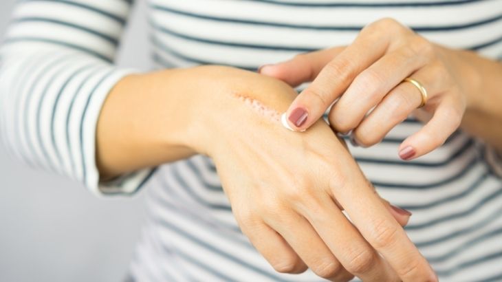 Yanığa ne iyi gelir