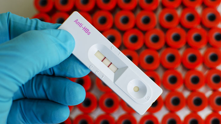 anti hbs (mikropartikül immün assay-meia veya benzeri)