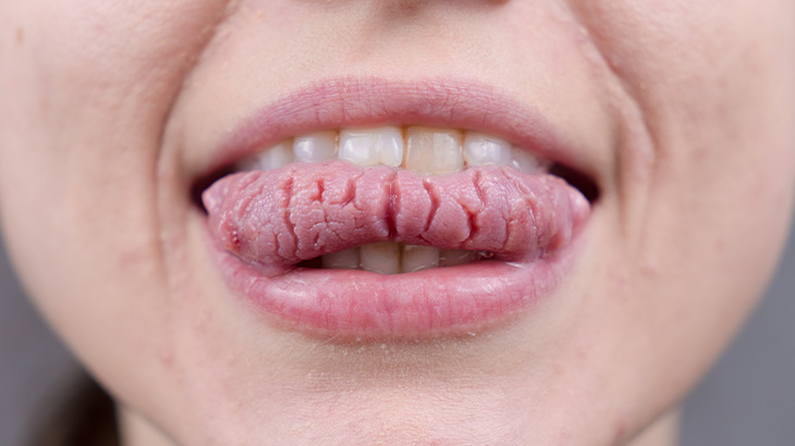 Coğrafik dil belirtileri arasında dilde yanma hissi, yüzey değişiklikleri ve zaman zaman hassasiyet görülebilir. 