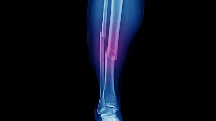 Fasyotomi işleminde fasya adı verilen bağ dokusuna atılan kesilerle cerrahi işlem gerçekleşir.