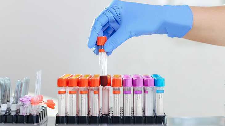 Transferrin Satürasyonu