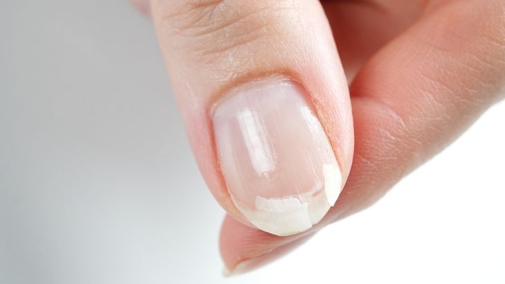 Sık tekrarlayan tırnak kırıkları, altta yatan beslenme yetersizliklerinin işareti olabilir.
