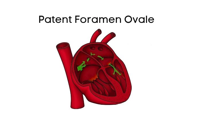 Çoğu zaman belirti vermeyen PFO, bazen bireylerde ani felç, baş ağrısı ya da nefes darlığı gibi sorunlara zemin hazırlayabilir.