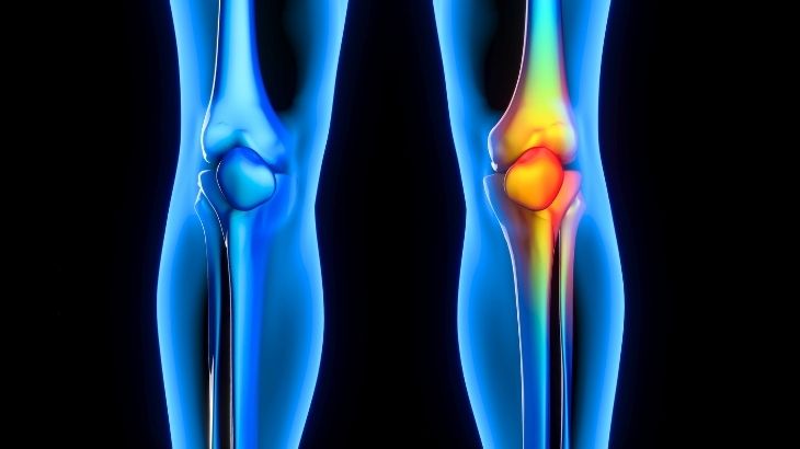 MRI hasarın boyutunu, yerini ve derecesini belirlemede oldukça hassastır.