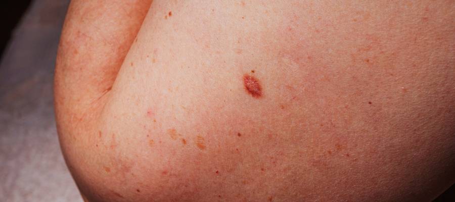 Omuz bölgesinde görülen, cilt üzerinde kırmızımsı kahverengi renkte kabarık bir ben ve etrafta küçük cilt lekeleri