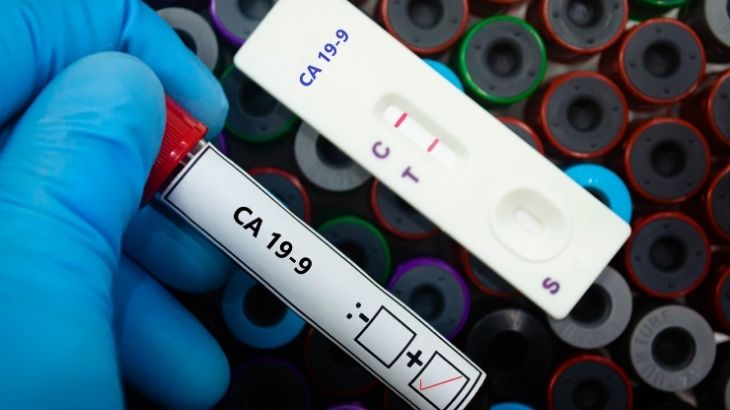 CA 19-9, sindirim sistemi kanserlerinin takibinde kullanılan bir testtir.