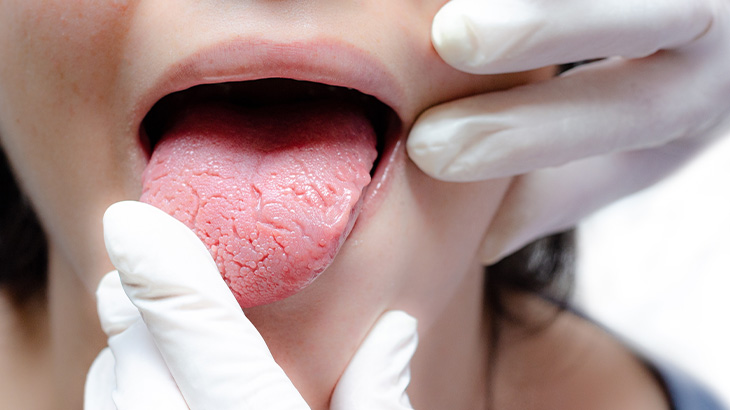 Harita dil, hormonal değişiklikler ve bazı gıdalara karşı duyarlılıkla ortaya çıkabilir. 