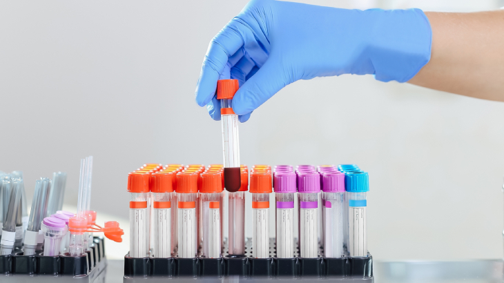 ANA testi, lupus şüphesiyle yapılan bir tarama testi olarak büyük önem taşır.