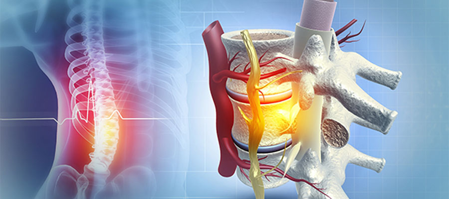 Bel omurgasında sinir sıkışmasını ve fıtıklaşmış diski gösteren tıbbi 3D görsel.