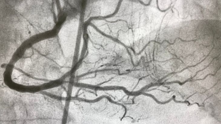Kronik total oklüzyonda kalp damarlarında belli bir süredir tıkanıklık mevcuttur.