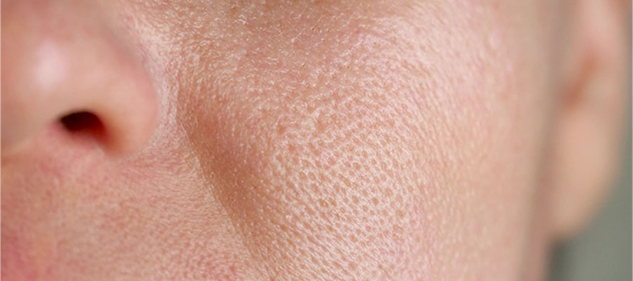 Yüz derisinde genişlemiş gözeneklerin yakından görünümü.