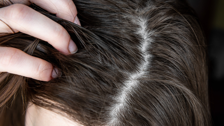 saç yağlanmasına ne iyi gelir