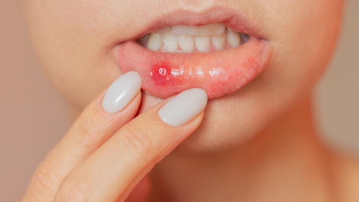 ağız yarası nasıl geçer
