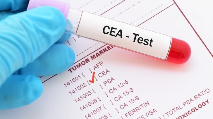 CEA testi kanser tedavisinin izlenmesinde tercih edilir.