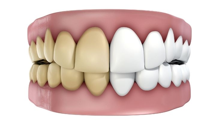 Diş sararmasının temel nedenlerinden biri doğru ve yeterli diş fırçalama alışkanlığının olmamasıdır.