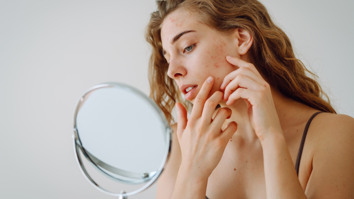 yetişkinlerde cilt problemleri: akne