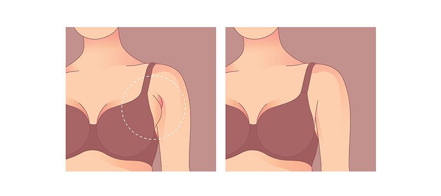 brakioplasti ve liposuction uygulaması