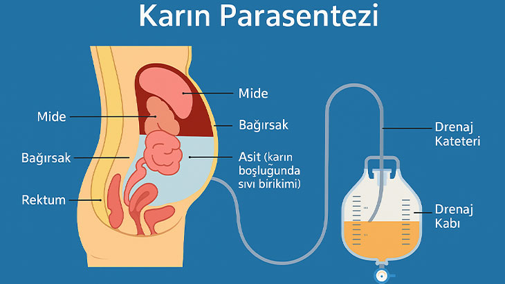 parasentez nedir