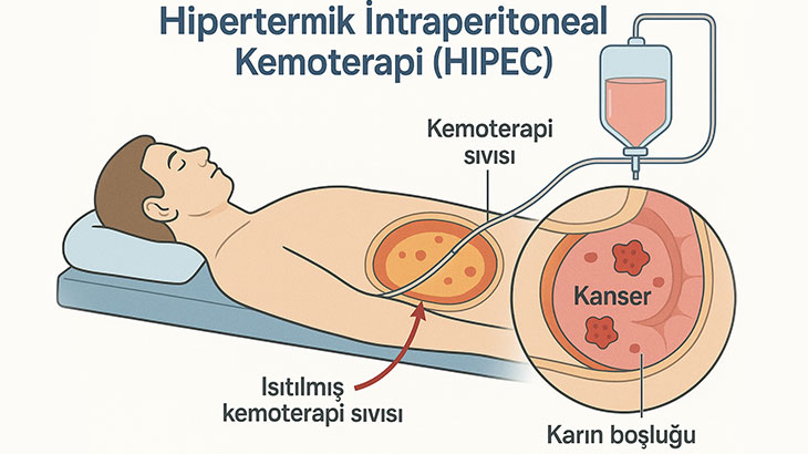 sıcak kemoterapi