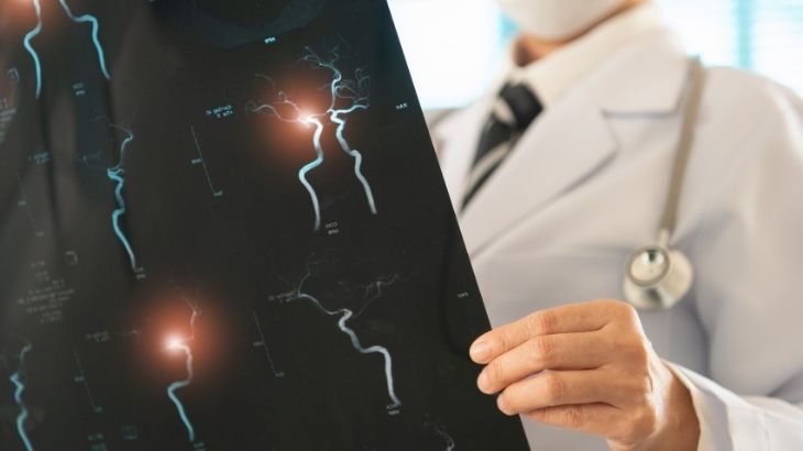 Beyin anjiyosu sayesinde birçok hastalık erken fark edilip tedaviye başlanabilir.