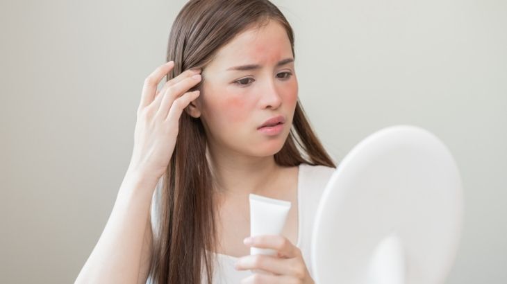 Yüz yanığına ne iyi gelir?