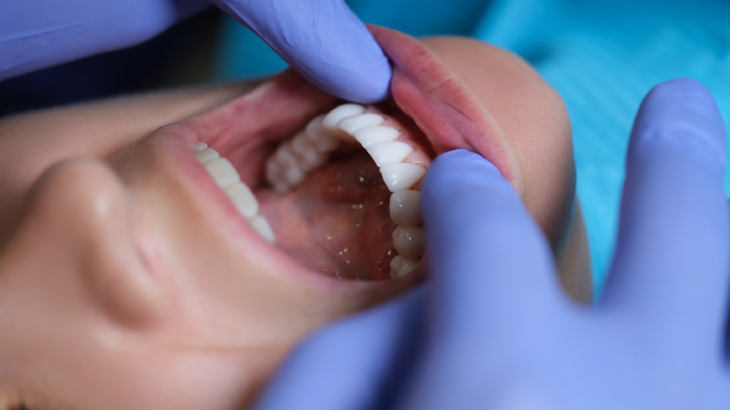 dil yarası nasıl geçer