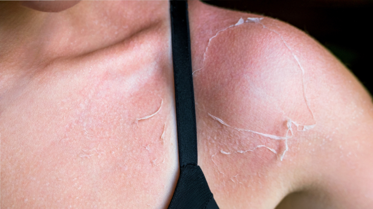 Deri soyulması gibi sorunların önüne geçmek için güneşe uzun süre maruz kalmamak ve güneş kremi kullanmak önemlidir.