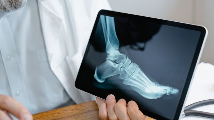Osteoid osteoma tümörü genelde gençlerde görülen, kemikte oluşan küçük ve iyi huylu lezyondur.