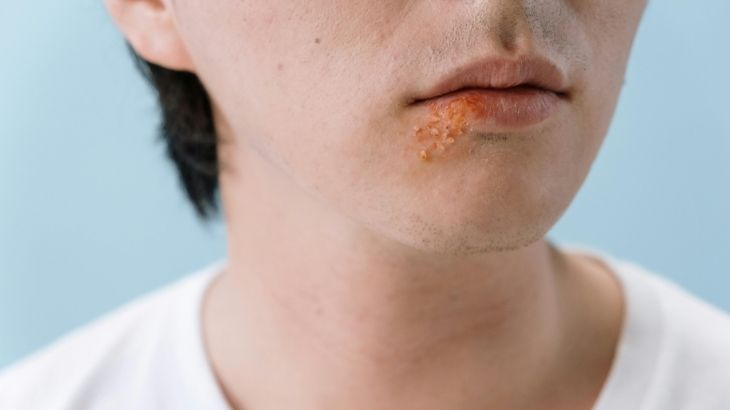 şap hastalığı nedir