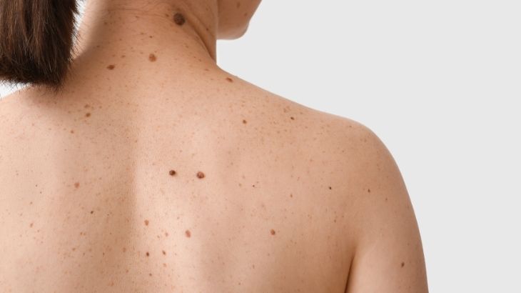 Malign melanom, ciltteki melanosit hücrelerinin kontrolsüz çoğalması ile oluşan ve hızla yayılan bir deri kanseri türüdür. 