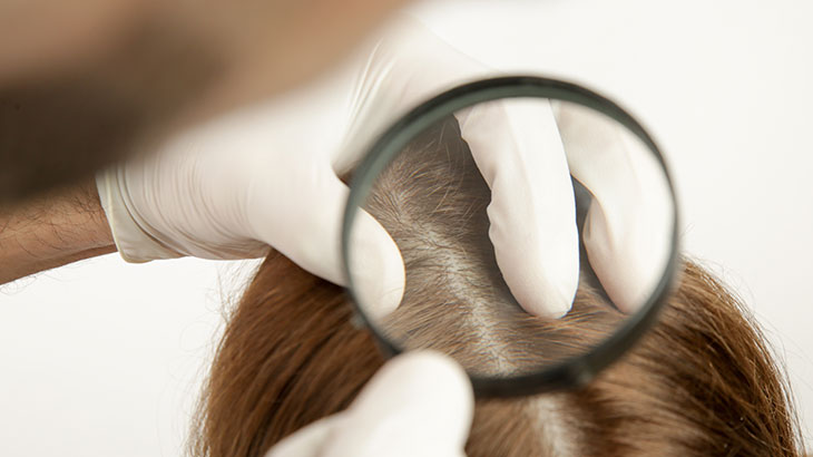 saç egzaması neden olur