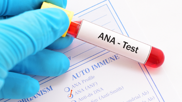 ANA testi, bağışıklık sisteminin hücre çekirdeğine karşı geliştirdiği antikorları saplamak için uygulanan kan testidir. 