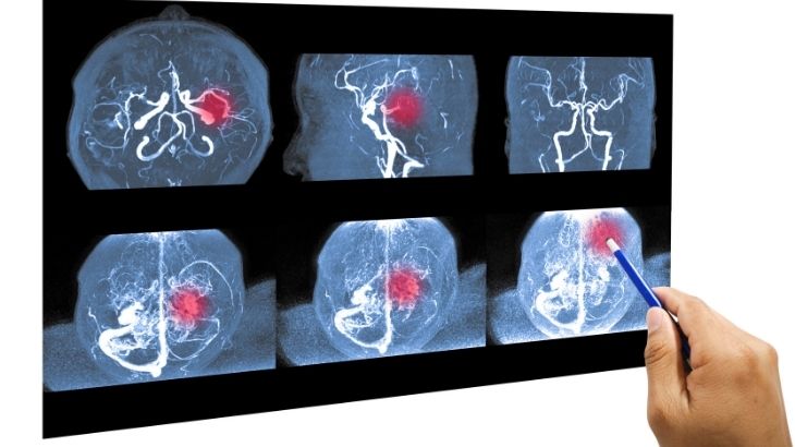 Beyin anjiyosuna aç karnına gitmek gerekir.